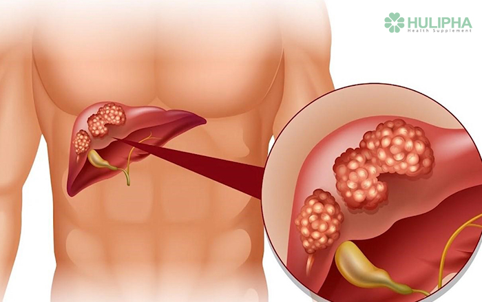 Huyền Thoại Y Học: Những Lầm Tưởng Về Bệnh Viêm Gan