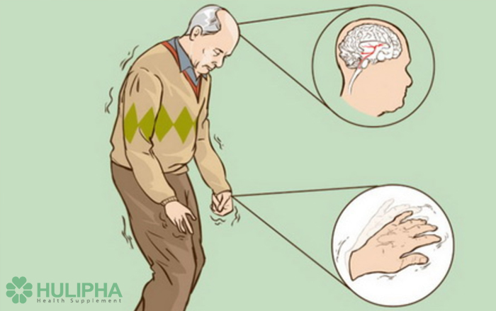 Huyền thoại y học: Những lầm tưởng về bệnh Parkinson